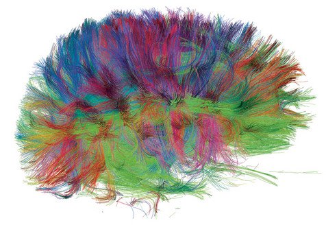 نوع جديد من مسوحات الدماغ يُظهر دوائر ومسارات عصبية سليمة في دماغ شخص بالغ