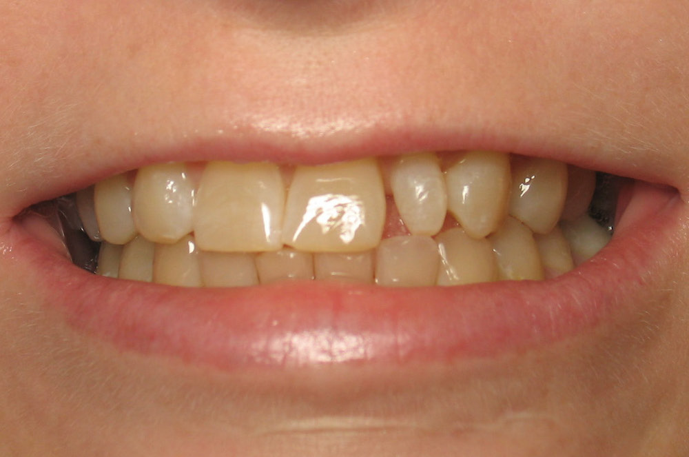 مقال - 6 أسباب غير مألوفة لإصفرار الأسنان