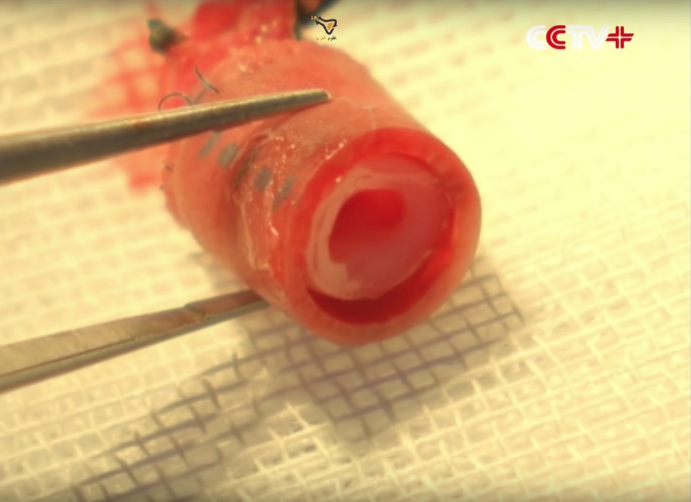 مقتطف - أول عملية زرع أوعية دموية مطبوعة بتقنية 3D تتم بنجاح!