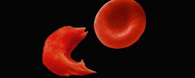 بتغيير شكل خلايا الدم الحمراء من الدائري إلى شكل شبيه بالمنجل