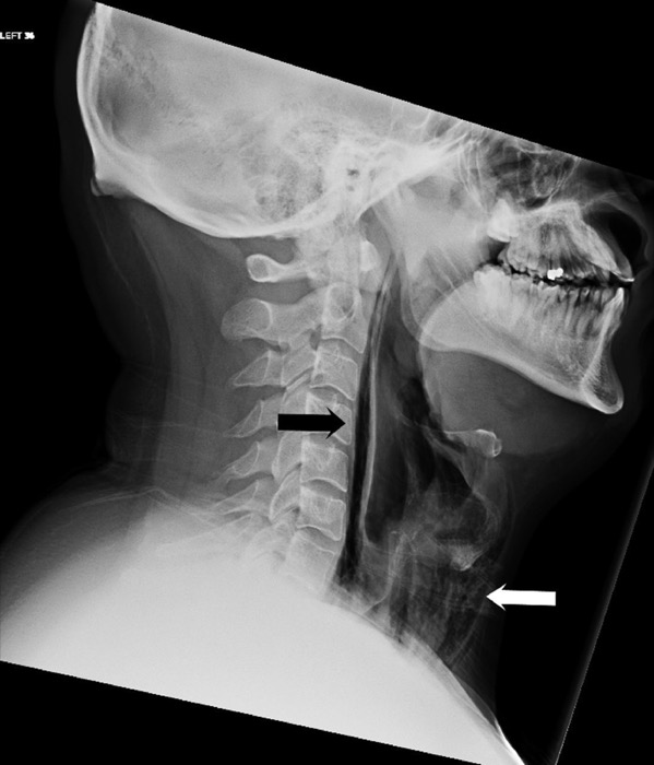 A radiograph of the man's throat shows streaks of air in the back of the throat (black arrow) and extensive surgical emphysema (white arrow).