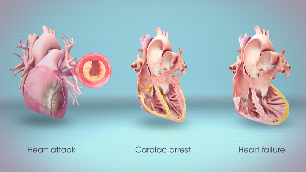 مقال - ما الفرق بين الذبحة الصدرية والنوبة القلبية والسكتة القلبية؟
