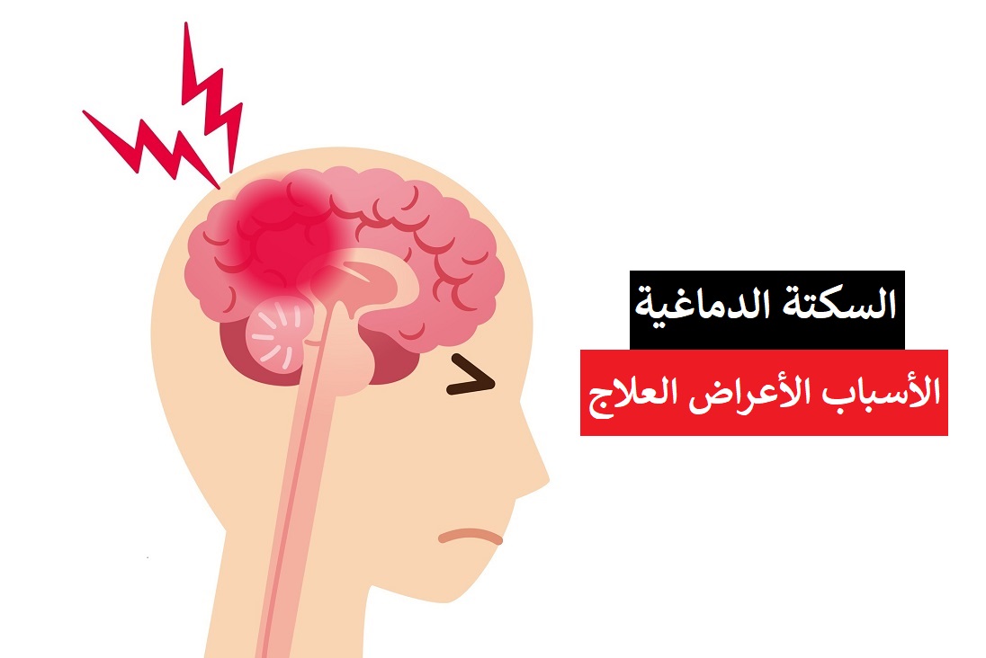 مقال - السكتة الدماغية .. الأسباب و الأعراض و العلاج