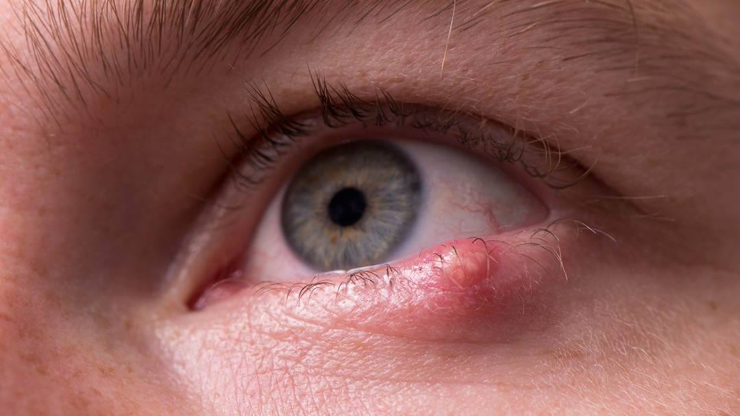 مقال - ما هو مرض شعيرة العين؟