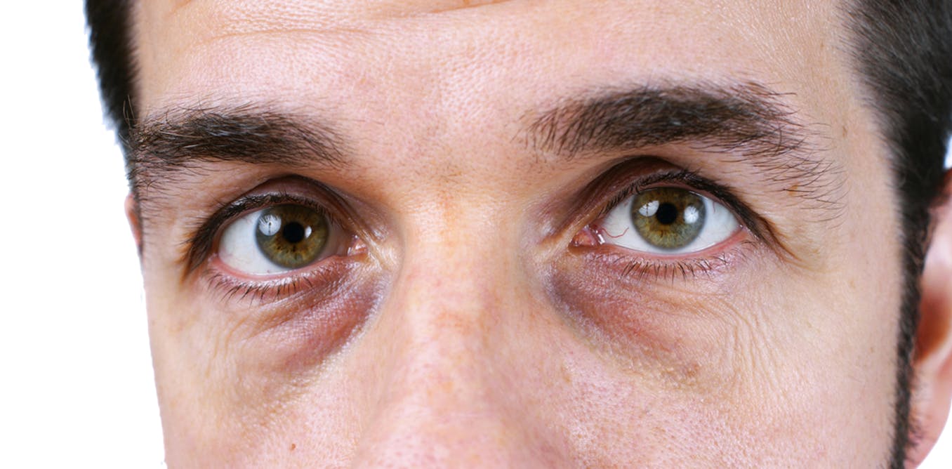 الهالات السوداء حول العين .. كيف تنشأ؟ وما علاجها؟