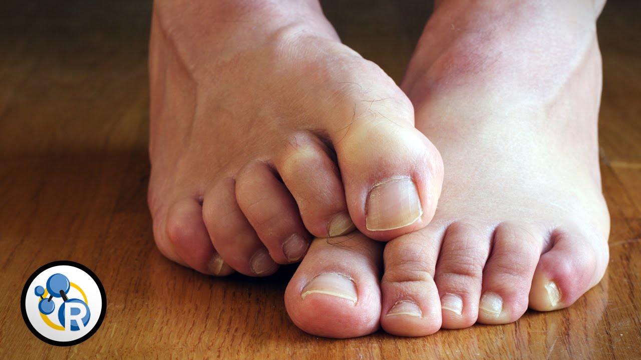 مقال – أبرز أسباب تعرّق الأقدام وطرق علاجها