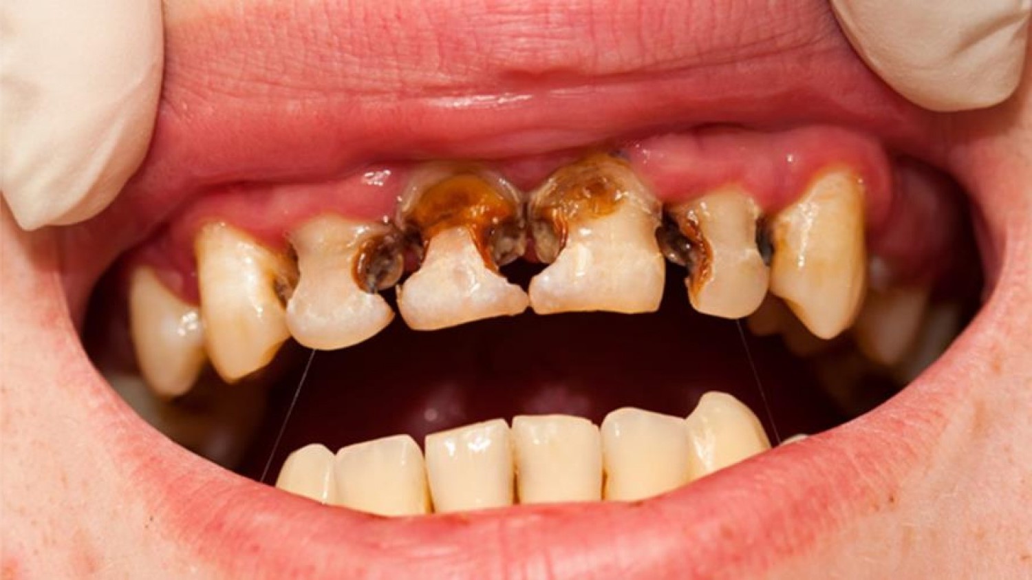 مقال – المشروبات الغازية تؤدي إلى تآكل الأسنان