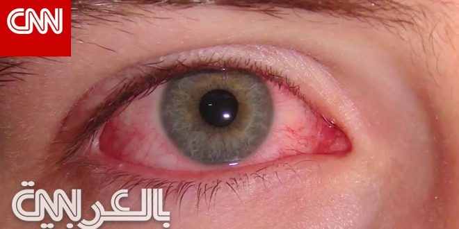 ما أسباب ظهور الدم في زاوية العين؟