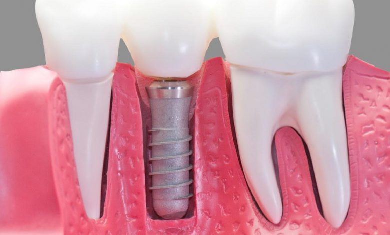 5 أسباب قد تؤدي لسقوط الأسنان في عمر مبكّر