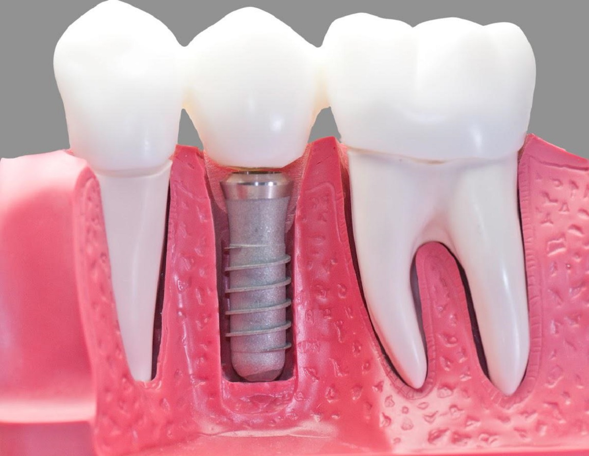 5 أسباب قد تؤدي لسقوط الأسنان في عمر مبكّر