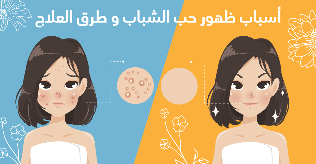 أسباب ظهور حبّ الشّباب و طرق العلاج