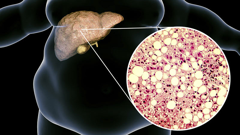 ما هو مرض الكبد الدهني وكيف نتخلص منه؟