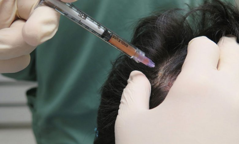 حقن البلازما للشعر : طريقة جديدة لعلاج تساقط الشعر