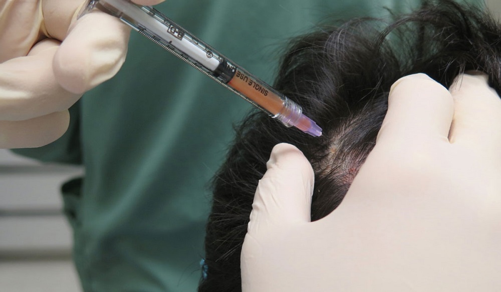 حقن البلازما للشعر : طريقة جديدة لعلاج تساقط الشعر
