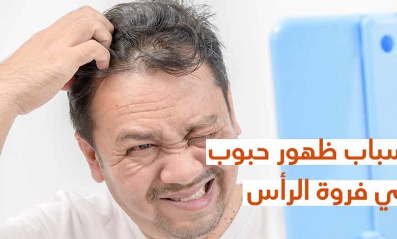 ماهي أسباب ظهور البثور على الرأس ؟
