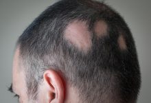 تعرّف على ثعلبة الشعر و كيف يمكن علاجها ؟