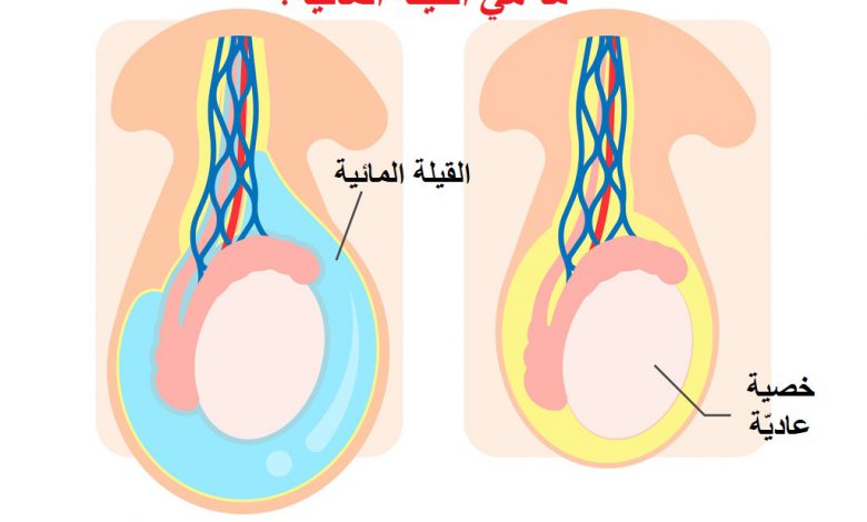 ما هي القيلة المائية؟ و طرق علاجها